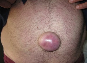 Umbilical Hernia  Op. Dr. Mehtap ERTÜRK